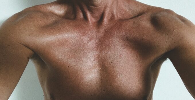 Photo Hyperthyroidism